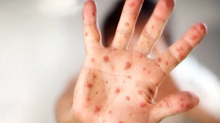 Measles cases on the rise in the U.S.