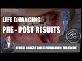 Before and After | Dental Braces | Clear Aligner | Cosmetic Dentist | Orthodontist | Dentistry