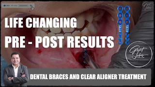 Before and After | Dental Braces | Clear Aligner | Cosmetic Dentist | Orthodontist | Dentistry
