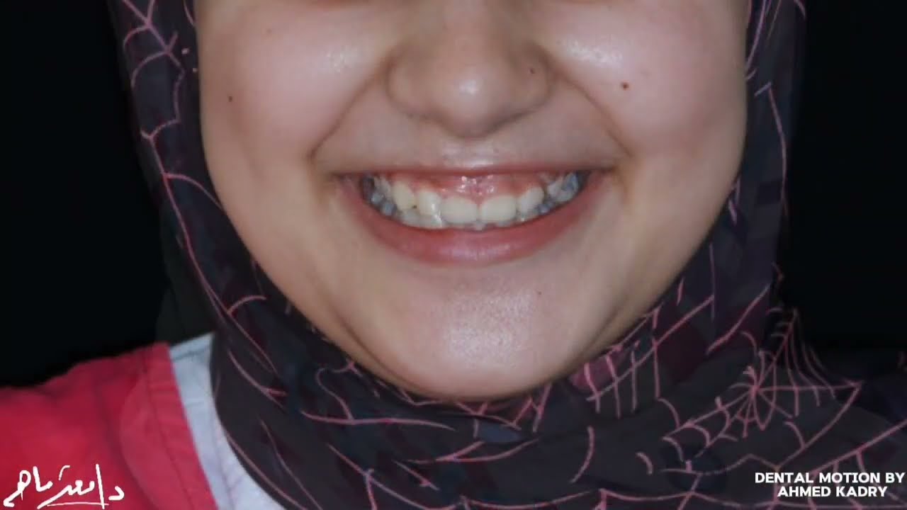 حل الابتسامة اللثوية والناب المدفون بالتقويم impacted canine