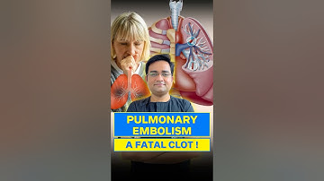 From Leg Clot to Pulmonary Embolism | The Hidden Danger of DVT