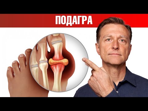 Тайна подагры раскрыта! Что вызывает подагру на самом деле? 😲