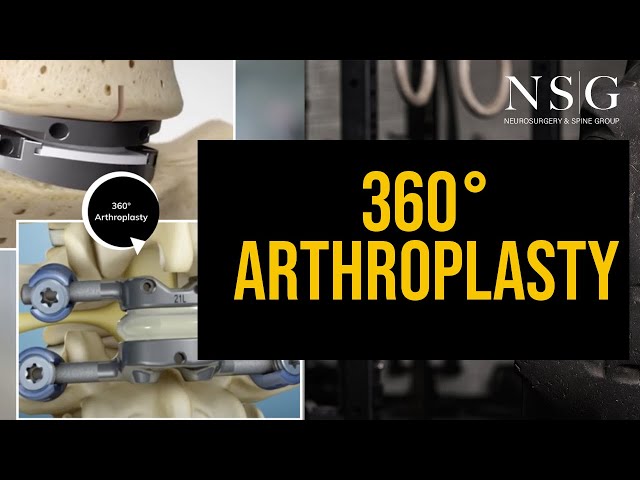 NSG - 360 Arthroplasty