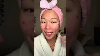 putting a pimple patch on my juicy chest pimple 🤢 #acne #keloids #pimplepatch 
