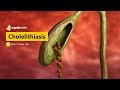 Cholelithiasis - I | Gastroenterology Medicine Animation | V-Learning | sqadia.com