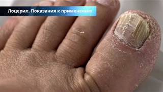 Лоцерил (лак, мазь) от грибка ногтей - цены, отзывы, аналоги, инструкция по применению препарата