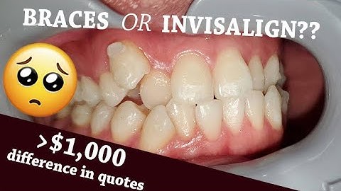 Smile Again! (My teeth alignment / Invisalign journey) #1: Shopping around & cost