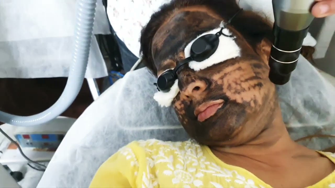 HANDS ON TRAINING ON LASER CARBON PEEL FACIAL