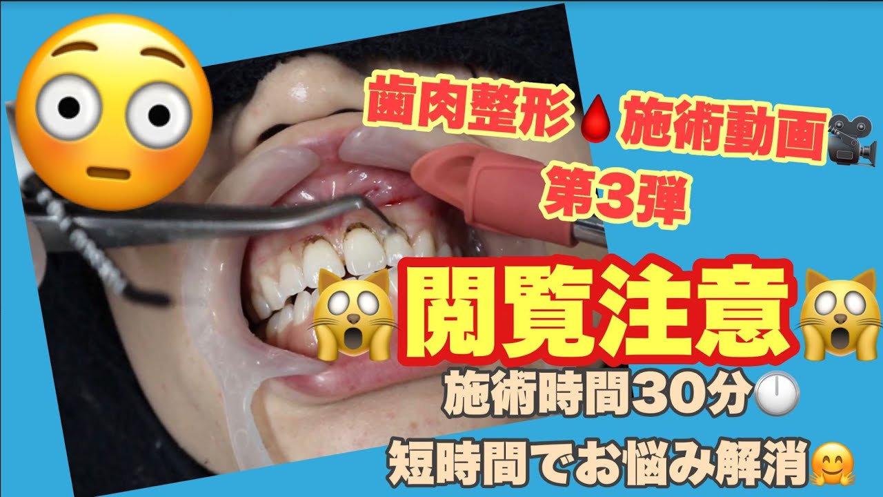 歯肉整形 南青山矯正歯科 審美歯科