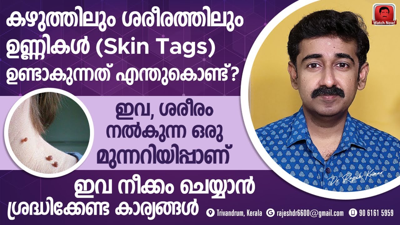 കഴുത്തിലും ശരീരത്തിലും ഉണ്ണികൾ (skin tags) ഉണ്ടാകാൻ കാരണമെന്ത് ? ഇത് എങ്ങനെ പരിഹരിക്കാം ?