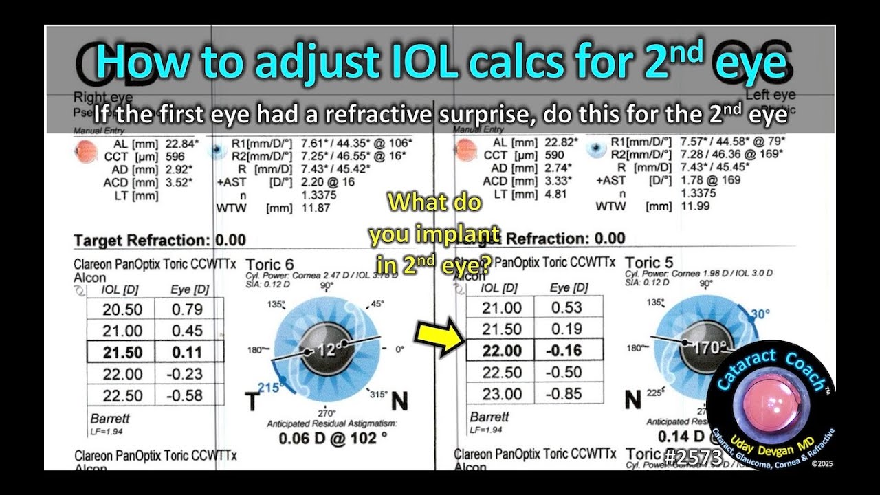 CataractCoach™ 2573: How to adjust IOL calcs for the 2nd eye cataract ...