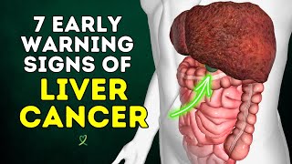 7 Early Warning Signs of Liver Cancer by MLC 1,844 views 3 weeks ago 13 minutes, 8 seconds