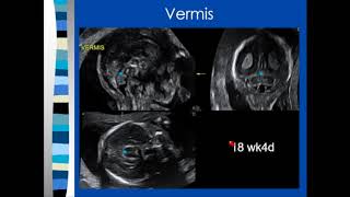 3D Ultrasound of Craniofacial Abnormalities