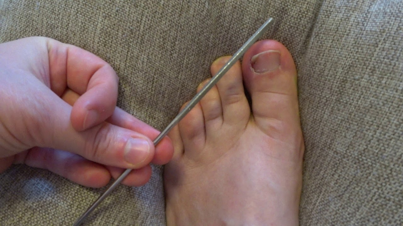 Вросший ноготь как самому излечить даже оперерованный! Без подолога и ...