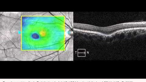Optical Coherence Tomography Video Through a Conforming Focal Choroidal Excavation