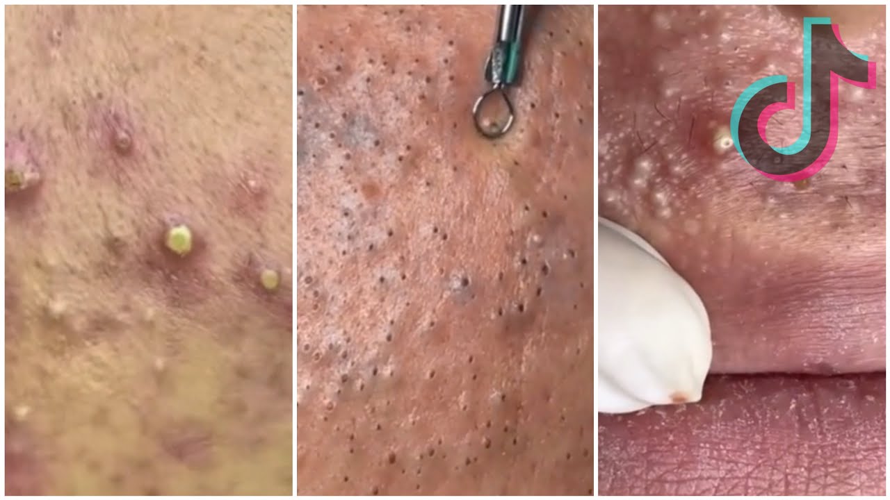 Extremely satisfying blackheads exfoliation, for blackheads and pimples TikTok compilation : pt. 3 :
