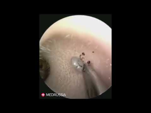 Удаление клеща из уха
