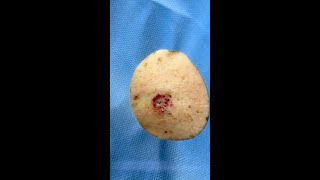 Quick removal of a small cyst dermatologist shorts | CONTOUR DERMATOLOGY