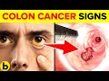 11 Early Signs Of Colon Cancer You NEED TO KNOW