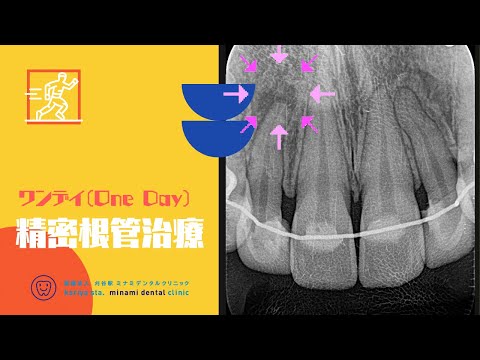 精密根管治療 　【愛知県刈谷市の歯医者】　初回根管治療　一回で終わる　バイオセラミックシーラー　ラバーダム防湿　自由診療　顕微鏡歯科　マイクロスコープ　Kariya city　Aichi