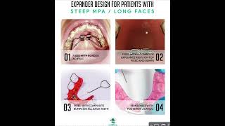 Expander  or RPE Design for Patients with Long Faces and Steep MPA
