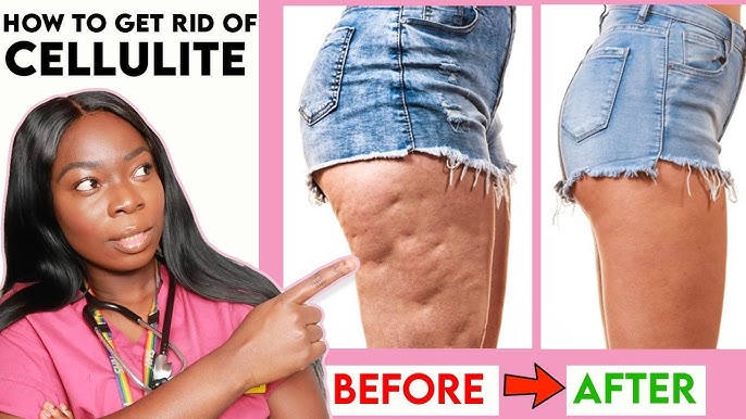 5 Ways To Understanding And Addressing Cellulite 2024