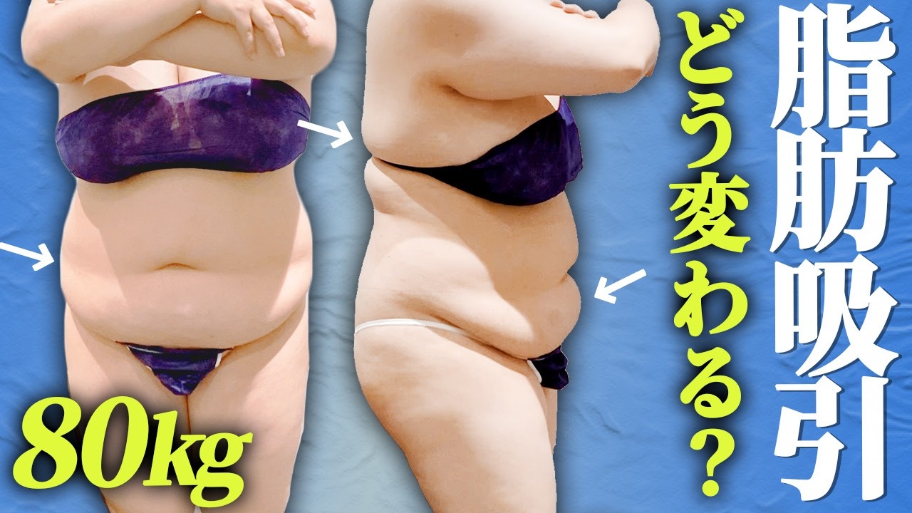 40代】BMI36の上半身1万cc脂肪吸引！お腹の1ヶ月後の経過＆背中の施術