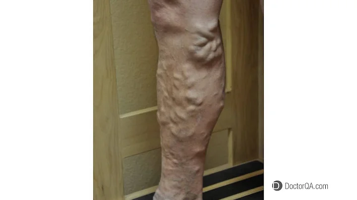 Why is it important to get varicose veins treatmen...