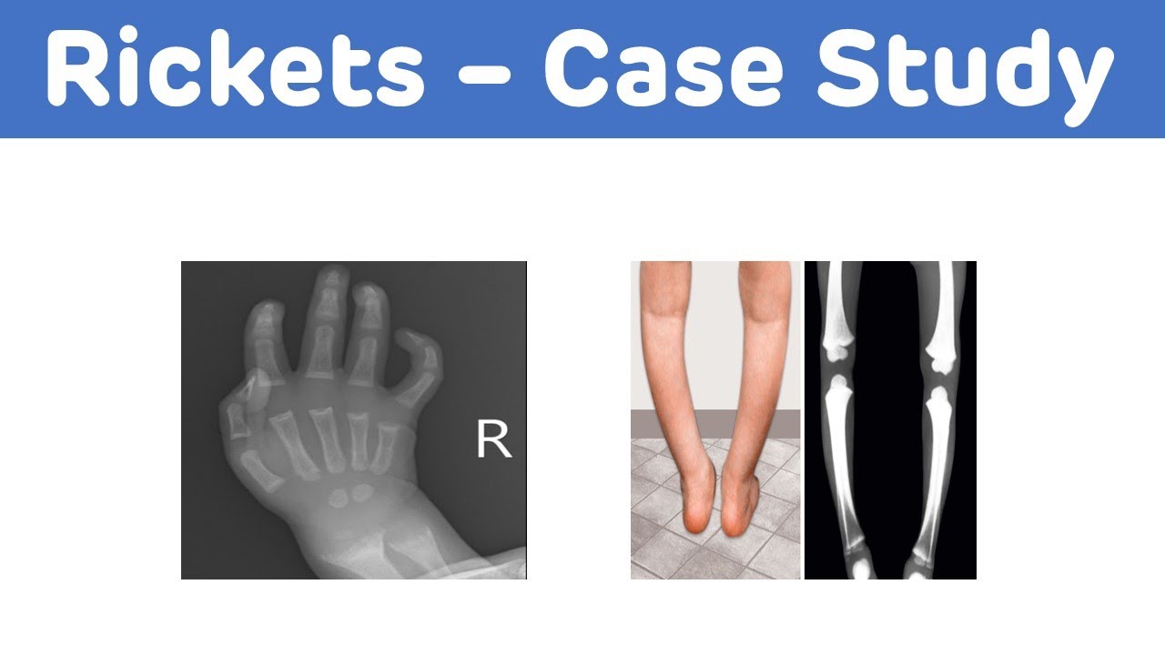 Rickets Case Study Rickets Biochemistry Case Study YouTube