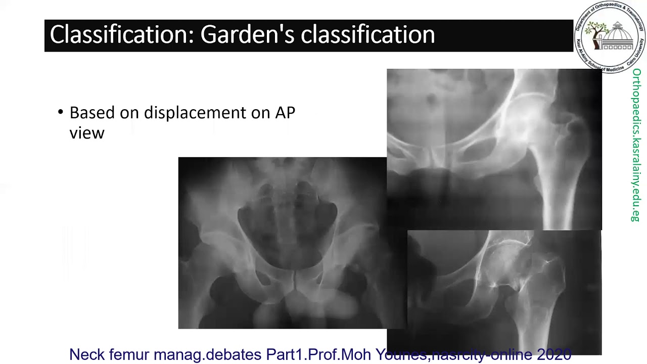 Neck femur management debates Part 1, Prof Mohamed Younes, nasrcity covid19 online lectures 2020