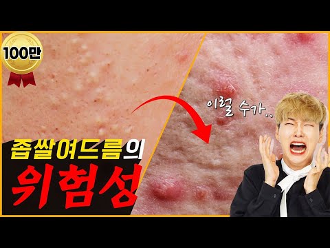 좁쌀여드름 예방&없애는 방법!│좁쌀여드름의 위험성│고민해결 (feat.염증성 여드름) l 白ニキビの予防&無くす方法 ! l 白ニキビの危険性！悩み解決 (feat.炎症性ニキビ)