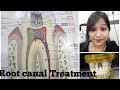 Root Canal Treatment ||दन्त नली चिकित्सा || dentist story||