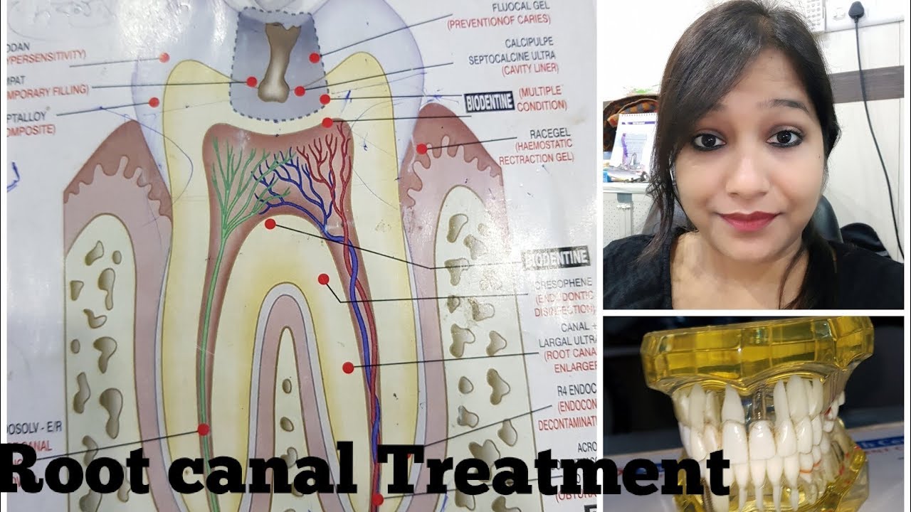 Root Canal Treatment दन्त नली चिकित्सा dentist story YouTube