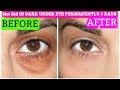 How To Get Rid Of Dark Circles In 3 Days Permanently | SuperPrincessjo
