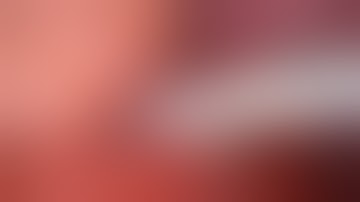 VATS bilobectomy (Right Upper+Right Middle Lobe)