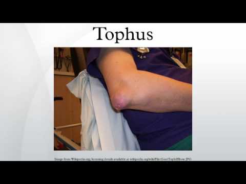 Vídeo: Tophus En Gota: Eliminación De Tophi, Tratamiento Y Más
