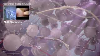 Rezum 3D Procedure Animation Patient Video