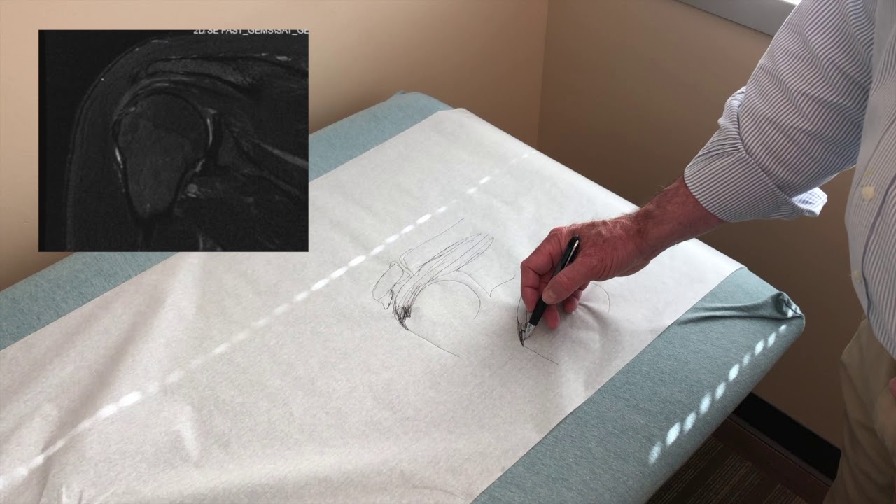 Partial Rotator Cuff Tear