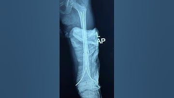Titanium Elastic Nail System (TENS) #legs #femur #nail #pead #children #baby #fracture #bone#ortho