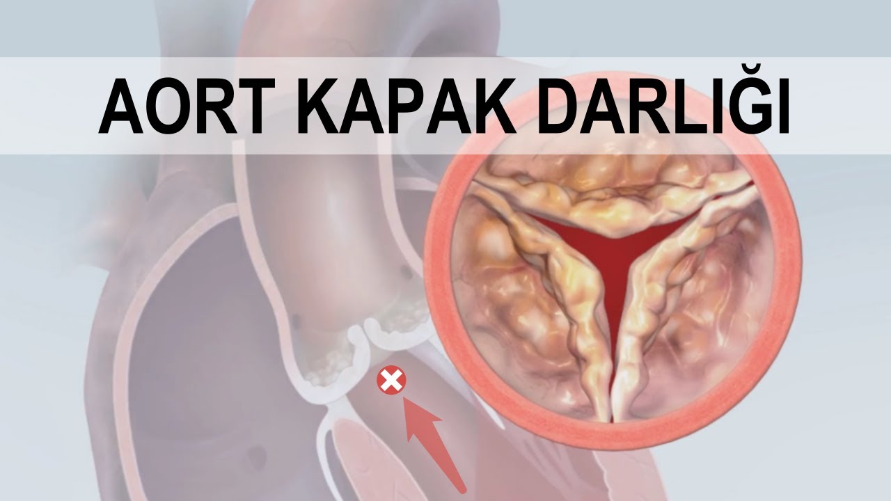 TAVI Procedure 6 TAVI Procedure