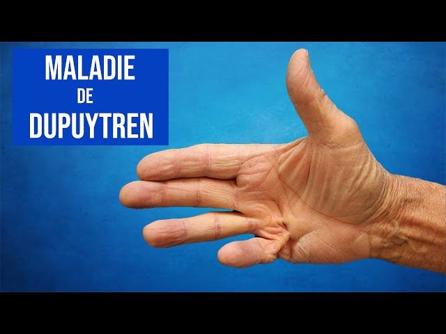 Maladie de Dupuytren : Traitements et Exercices Kiné