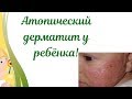 Атопический дерматит у ребёнка!😳👶Как маме помочь самой малышу!