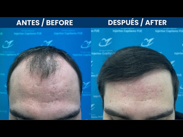 Injerto Capilar Lima 3249 folículos (7949 pelos)
