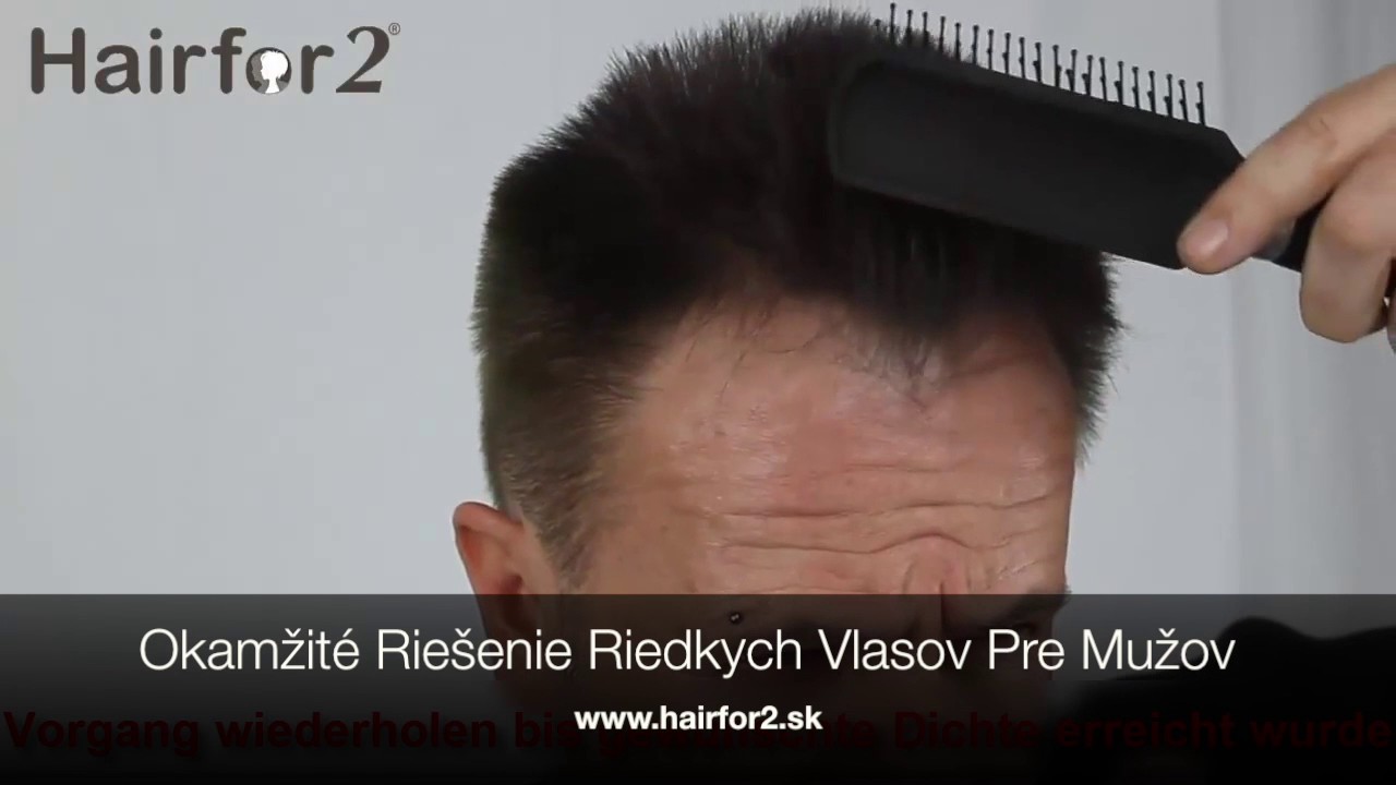Okamžité Riešenie Riedkych Vlasov u Mužov