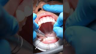 tone Tartar Teeth 😱 Deep Cleaning &amp; Natural Whitening Transformation
