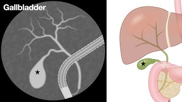 ERCP-Basics for Nurses & Techs - audio review from NoteBookLM