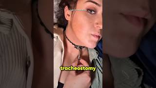Tracheostomy Device Explained
