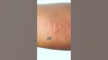 Which Is Better Blood Test Or Scratch Test?