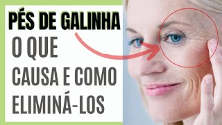 Pés de galinha  o que causa e como eliminálos