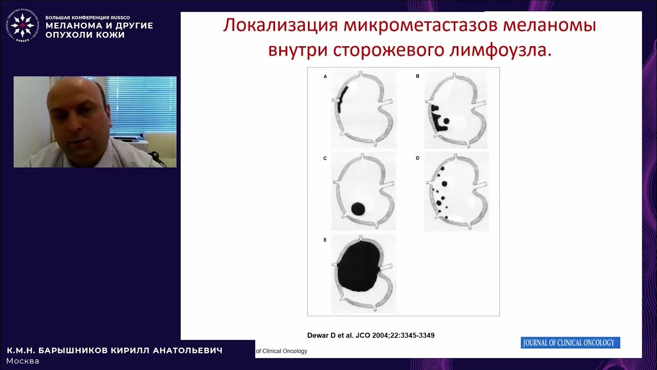 Биопсия при меланоме